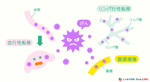 悪性新生物(がん)の転移