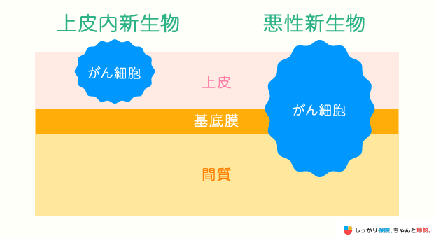 上皮内心生物と悪性新生物の違い